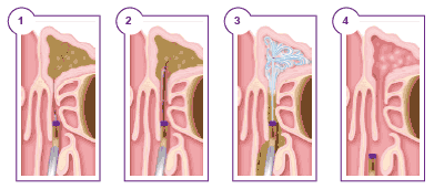 Sinuplasty Steps